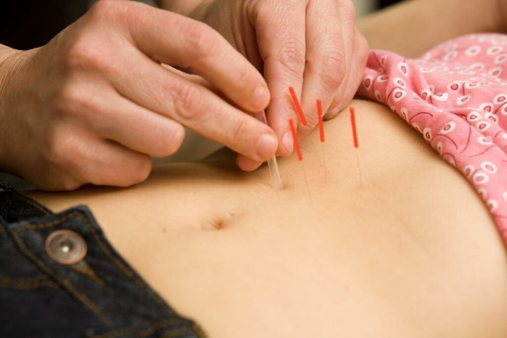 Acupuncture Applied to a persons Stomach